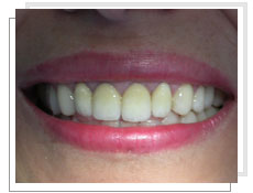 Photo après l'intervention de la prothèse céramo - céramique avec la reconstitution des dents 