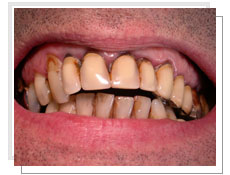 Photo avant l'intervention de la prothèse céramique sur dent naturelle 