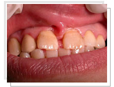 Photos avant l'intervention de l'implantation dentaire conventionnel et liaison avec dents naturelles supérieures