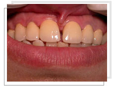 Photos après  l'intervention de l'implantation dentaire conventionnel et liaison avec dents naturelles supérieures