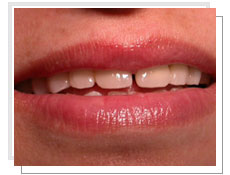 Vue de face avant  l'intervention de l'implantation dentaire conventionnel et liaison avec dents naturelles supérieures