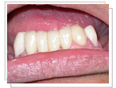 Photo avant la pose des implants dentaires conventinnels avec liaison dents-implants