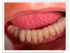 Photo après la pose des implants dentaires conventinnels avec liaison dents-implants