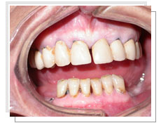 Photo avant la pose des implants dentaires conventinnels et liaison dents-implants