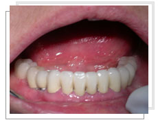 Photo après la pose des implants dentaires conventinnels et liaison dents-implants