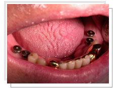 Photo avant la pose des implants dentaires conventinnels avec liaison dents naturelles 