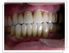 Photo après la pose des implants dentaires conventinnels avec liaison dents naturelles: bridge céramique complet fixe avec mise en charge immédiate