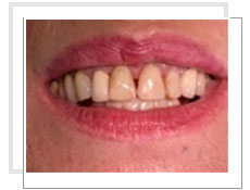 Photo avant la pose des implants dentaires conventinnels avec liaison dents naturelles 