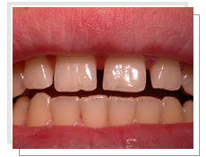 Photo avant le collage des facettes céramiques: les dents sont légèrement mal positionnées