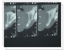 Photo de la radio panoramique dentaire: l'épaisseur osseuse est insuffisante