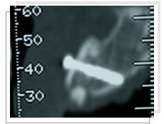 Photo de la radio panoramique dentaire: l'épaisseur osseuse est assez favorable après la fixation de la greffe osseuse  par un mini-vis