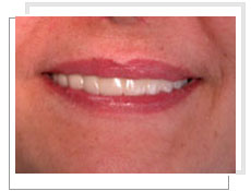 Photo après la pose de implants dentaires: après 6 mois fixation définitive d’un bridge fixe de 12 éléments céramiques 