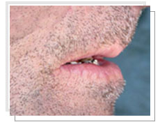 Photo avant la pose de implants dentaires: édentement total supérieur et inférieur 