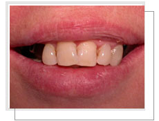 Photo avant la pose de deux implants dentaires de chaque côté droit et gauche: endentement supérieur bilatéral 