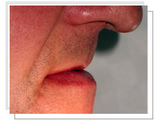 Photo avant la pose de 4 implants maxillaires: la lèvre supérieure est non soutenue et rentrante 