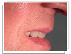 Photo après la pose de 4 implants maxillaires et la fixation d'un bridge céramique après 6 mois: la lèvre supérieure est  soutenue 