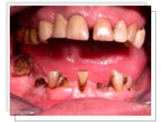 Photo avant l'opération de l'extraction et la pose des implants immédiatement: les dents inférieures sont en mauvais état 