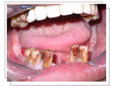 Photo avant l'extraction de toutes les dents inférieures et la pose des implants immédiatement: les dents inférieures sont déchaussées et mobiles