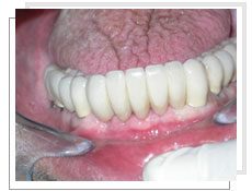 Photo après l'extraction de toutes les dents inférieures et la pose des implants immédiatement