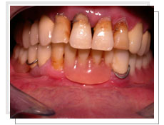 Photo avant l'opération de l'extraction et la pose des implants immédiatement: les dents inférieures sont en mauvais état 