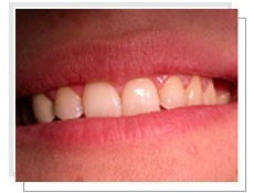 Photo avant la pose d'un implant dentaire avec mise en esthétique immédiate: absence de la 2ème prémolaire supérieure gauche 