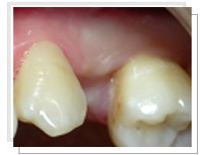 Photo avant  l'implantologie dentaire avec mise en esthétique immédiate: absence de la première prémolaire supérieure gauche 