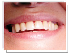 Vue de face avant la pose de 3 implants dentaires avec mise en charge immédiate: absence de la 2ème prémolaire et la molaire droite