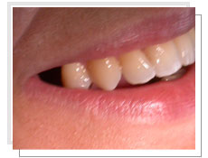 Vue de profil avant la pose de 3 implants dentaires avec mise en charge immédiate: absence de la 2ème prémolaire et la molaire droite