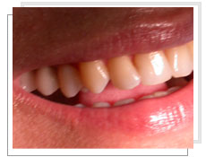 Vue de profil après la pose de 3 implants dentaires avec mise en charge immédiate