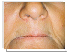Vue de face avant l'implantologie dentaire avec mise en charge immédiate: édentement total supérieur et inférieur