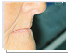 Vue de profil   avant l'implantologie dentaire dentaires avec mise en charge immédiate: édentement total supérieur et inférieur 