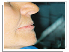 Vue de profil  après l'implantologie dentaire dentaires avec mise en charge immédiate