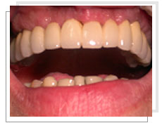Photo après la  pose de 6 implants dentaires et mise en charge immédiate par bridge céramique complet