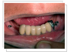 Photo avant la liaison dents-implants: pose de 3 implants dentaires 