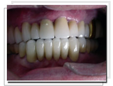 Photo après la pose d'implants dentaires avec mise en charge immédiate: liaison dents-implants