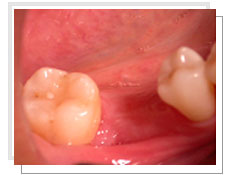 Photo avant l'intervention de l'implantologie dentaire avec mise en esthtique immdiate: absence de la premire prmolaire infrieure gauche 